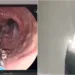 Vídeo: Detento engole lâmina de barbear pela segunda vez em presídio de Cruzeiro do Sul e vai parar no hospital