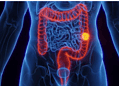 Aumento proporcional de casos de tumor no intestino entre mais jovens chamou a atenção de cientistas — Foto: Getty Images/via BBC