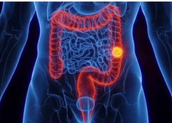 Aumento proporcional de casos de tumor no intestino entre mais jovens chamou a atenção de cientistas — Foto: Getty Images/via BBC