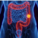 Aumento proporcional de casos de tumor no intestino entre mais jovens chamou a atenção de cientistas — Foto: Getty Images/via BBC