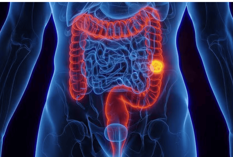 Aumento proporcional de casos de tumor no intestino entre mais jovens chamou a atenção de cientistas — Foto: Getty Images/via BBC