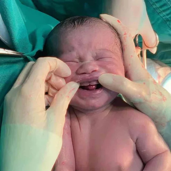 Bebê nasce com seis 'dentes' e surpreende equipe médica em MS; Veja vídeo