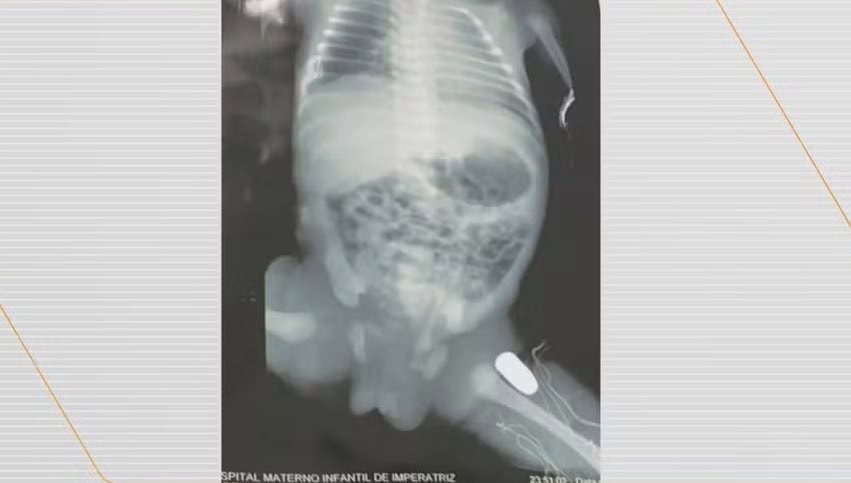 Grávida é baleada e tiro fica alojado na perna do bebê