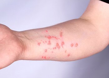Casos de mpox se aproximam de 100 mil em todo o mundo, alerta OMS
