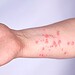Casos de mpox se aproximam de 100 mil em todo o mundo, alerta OMS