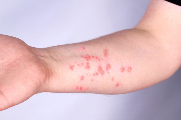 Casos de mpox se aproximam de 100 mil em todo o mundo, alerta OMS