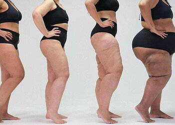 Foto: ONG Movimento Lipedema/Conheça Lipedema