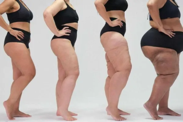 Lipedema: a "nova" doença na lista da OMS que talvez você tenha sem saber