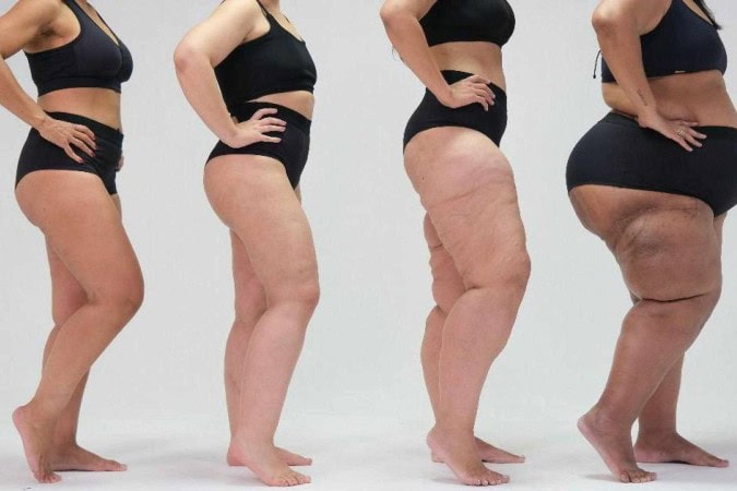 Foto: ONG Movimento Lipedema/Conheça Lipedema