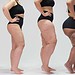 Foto: ONG Movimento Lipedema/Conheça Lipedema
