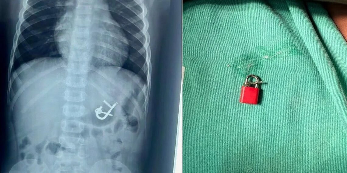 Criança engole cadeado com as chaves e passa por endoscopia para remoção • Dra. Thaís Sampaio