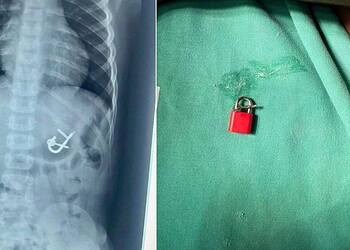 Criança engole cadeado com as chaves e passa por endoscopia para remoção • Dra. Thaís Sampaio
