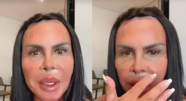 Gretchen retira preenchimento labial com substância polêmica após 20 anos