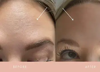 'Baby Botox': o fenômeno que é febre da Geração Z na busca da juventude eterna