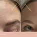 'Baby Botox': o fenômeno que é febre da Geração Z na busca da juventude eterna