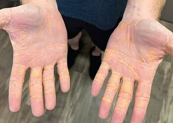 Nódulos só podem ser retirados com cirurgia — Foto: Divulgação/JAMA