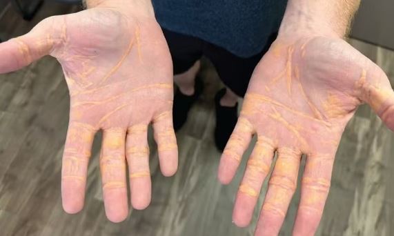 Nódulos só podem ser retirados com cirurgia — Foto: Divulgação/JAMA