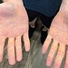 Nódulos só podem ser retirados com cirurgia — Foto: Divulgação/JAMA
