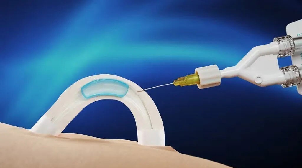 Adam é um hidrogel solúvel em água que é implantado nos canais que transportam o esperma • Contraline/Divulgação