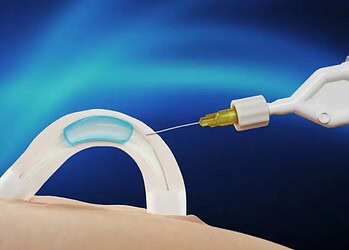 Adam é um hidrogel solúvel em água que é implantado nos canais que transportam o esperma • Contraline/Divulgação