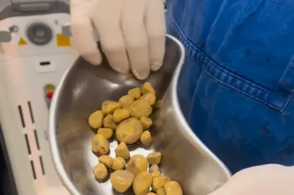 Médico retira 35 pedras da bexiga de homem que bebia refrigerante todo dia