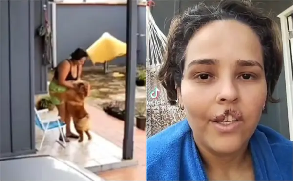 Técnica de enfermagem acreana atacada por próprio cachorro passará por cirurgia de reconstrução facial