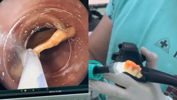 Médico retira prótese dentária por endoscopia em paciente no hospital de Cruzeiro do Sul; Veja vídeo
