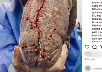 Bebê nasce com DIU grudado na pele — Foto: Instagram/Reprodução