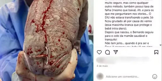 Bebê nasce com DIU grudado na pele — Foto: Instagram/Reprodução