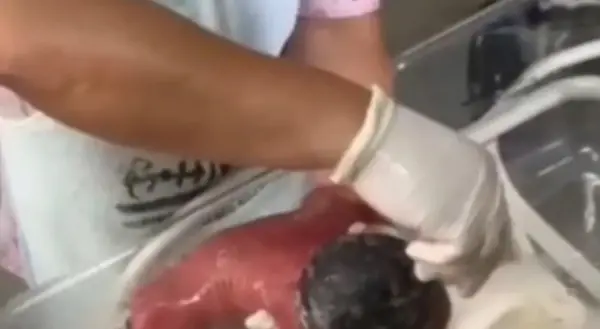 Bebê com queimaduras após banho em hospital do Acre será transferida para UTI especializada em Minas Gerais