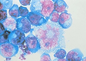 Células humanas infectadas: vírus permanece adormecido por anos  - crédito: Johns Hopkins Medicine/Divulgação