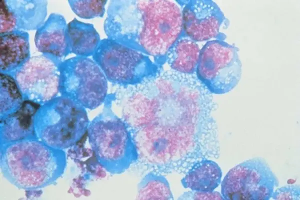 Cientistas avançam na cura para o vírus do HIV