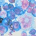 Células humanas infectadas: vírus permanece adormecido por anos  - crédito: Johns Hopkins Medicine/Divulgação