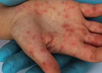 Manchas vermelhas pelo corpo são sintoma de sarampo — Foto: Febrasgo.org/Divulgação