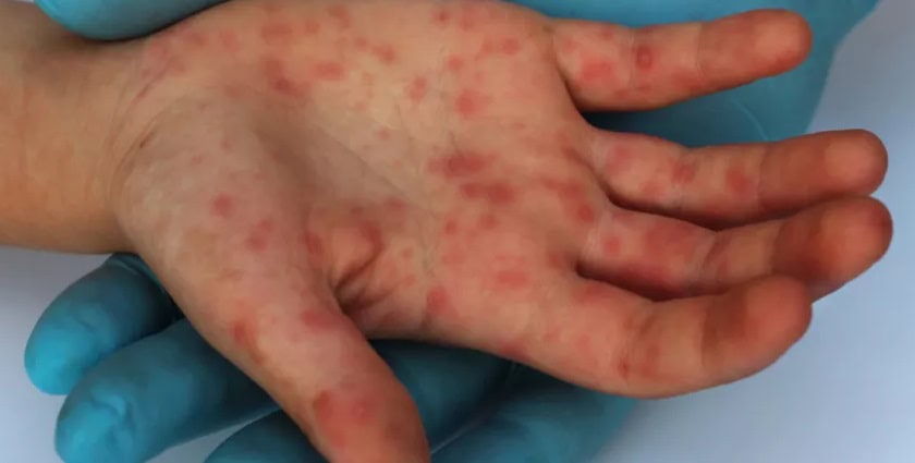 Manchas vermelhas pelo corpo são sintoma de sarampo — Foto: Febrasgo.org/Divulgação