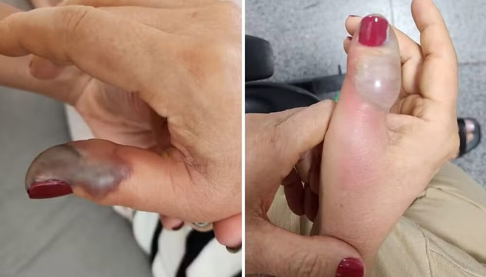 Fotos da mão de Marise Teixeira dois dias depois de fazer a unha e no dia da primeira cirurgia — Foto: Arquivo pessoal/Bruna Teixeira