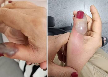 Fotos da mão de Marise Teixeira dois dias depois de fazer a unha e no dia da primeira cirurgia — Foto: Arquivo pessoal/Bruna Teixeira