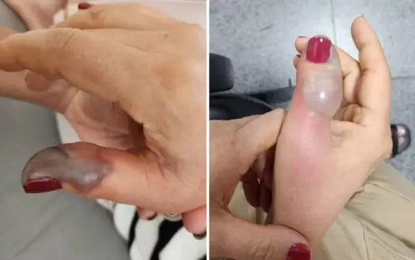 Mulher perde parte do dedo após fazer as unhas em salão e ter infecção, diz família