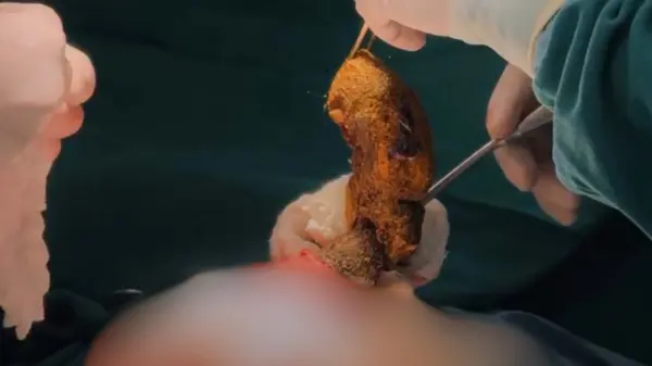 VÍDEO: Cirurgião do Acre retira bola de cabelo de estômago de criança em cirurgia rara