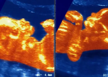 Médicos acreditam que durante a gestação, a placenta de cada um dos gêmeos teve algum tipo de contato e isso formou uma conexão de vasos sanguíneos que levou sangue do menino para a menina