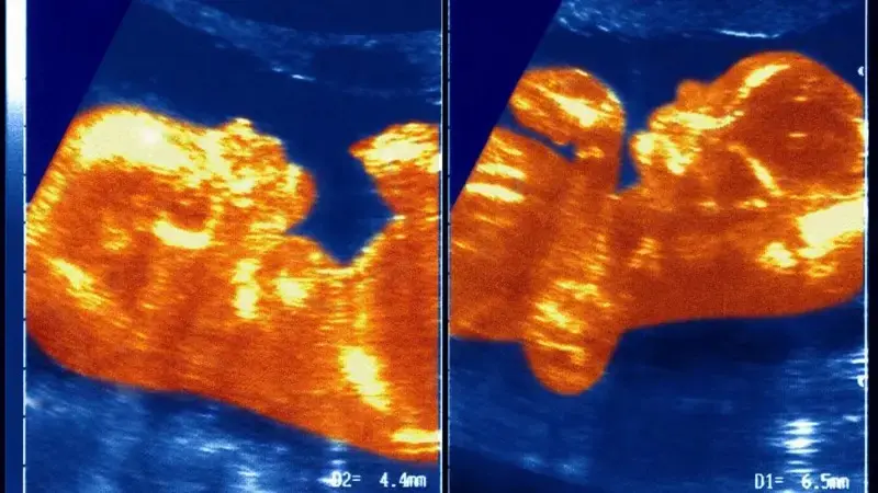 Médicos acreditam que durante a gestação, a placenta de cada um dos gêmeos teve algum tipo de contato e isso formou uma conexão de vasos sanguíneos que levou sangue do menino para a menina