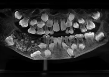 Foto: Saveetha Dental College and Hospitals/Divulgação