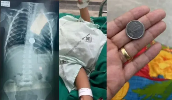 Menino de 5 anos engole moeda e vai parar no hospital para retirada do objeto no interior do Acre