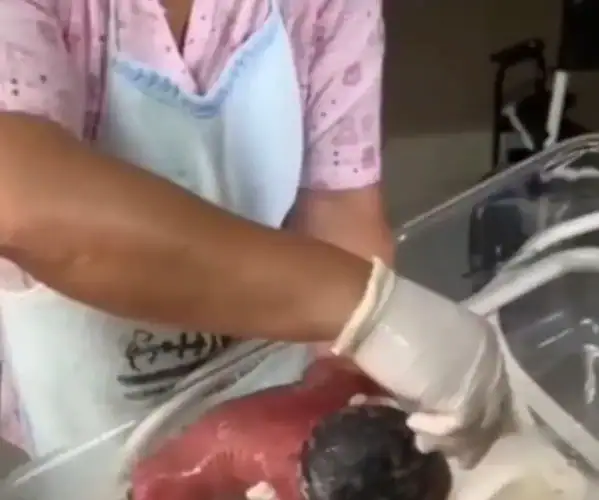 Exame descarta doença rara em bebê que sofreu queimaduras em maternidade no Acre e técnica segue afastada