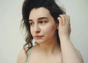 Acne geralmente afeta as mulheres adultas na região do queixo, mandíbula e — Foto: Reprodução/Pexels