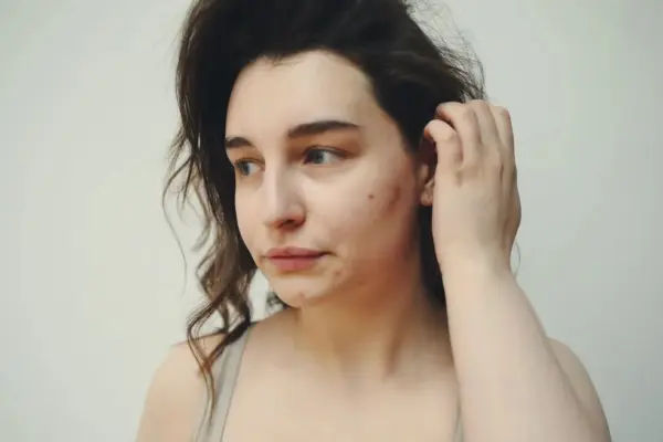 'Cirurgia da acne' x 'espremer espinhas': saiba o que faz mal na limpeza de cravos e espinhas