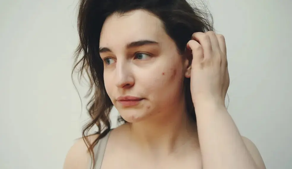 Acne geralmente afeta as mulheres adultas na região do queixo, mandíbula e — Foto: Reprodução/Pexels
