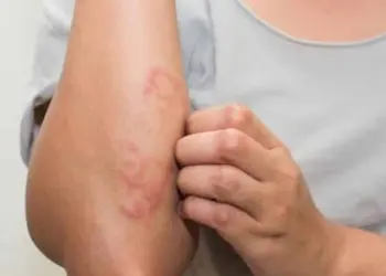 Hanseníase é uma doença infecciosa transmitida por meio de gotículas de saliva e secreções nasais de pessoas que não estão em tratamento. Foto: Ilustração