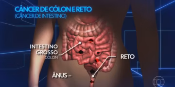 Mudanças simples no cotidiano podem reduzir em até 30% o risco de câncer de intestino; veja quais