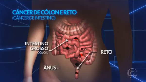 Mudanças simples no cotidiano podem reduzir em até 30% o risco de câncer de intestino; veja quais
